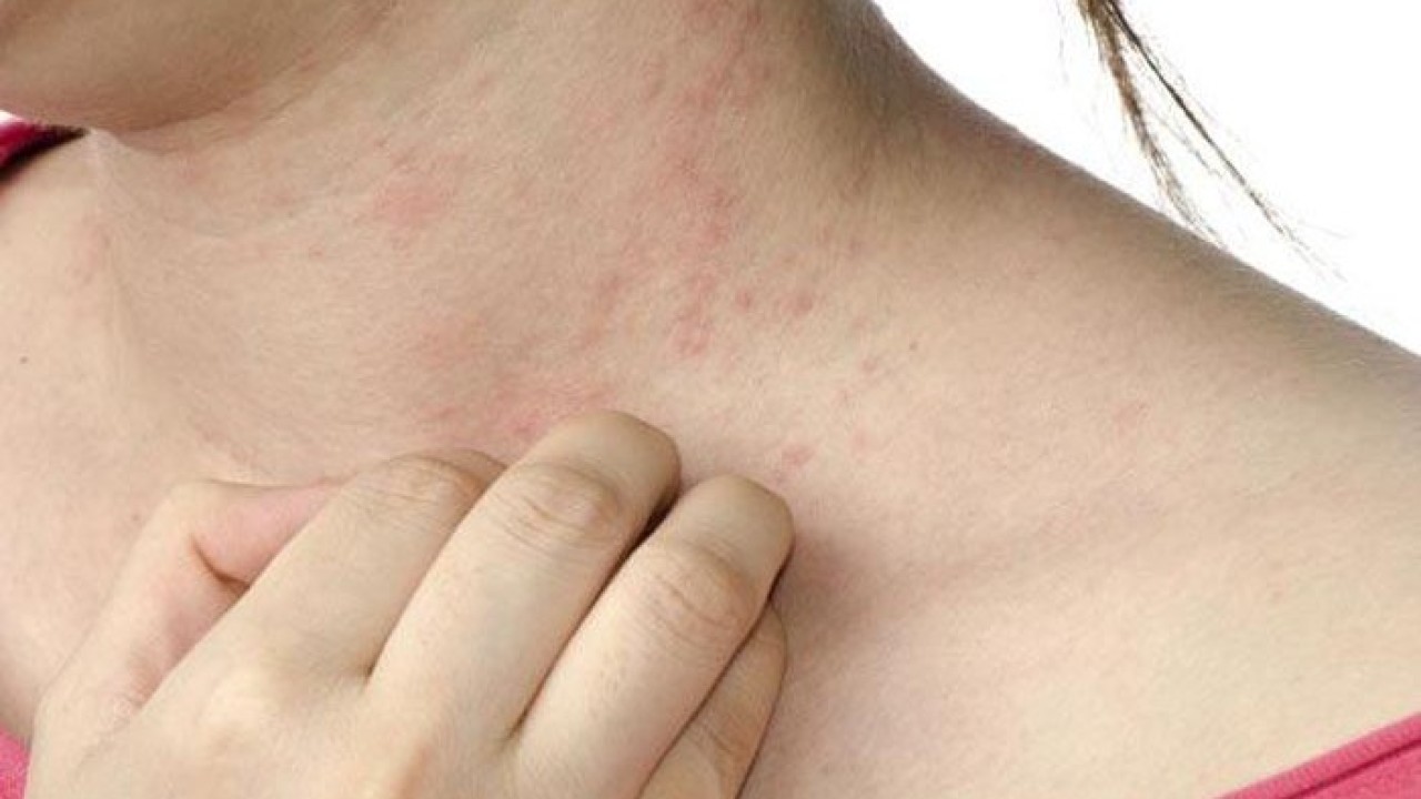 How Can You Protect Your Skin From Psoriasis This Winter Season?
